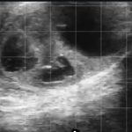 Follicular Cysts with Trabeculae in Cattle